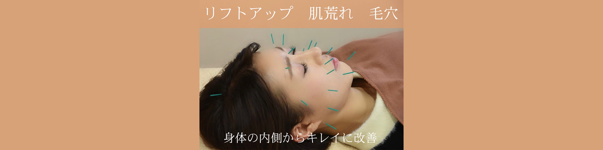 美容鍼